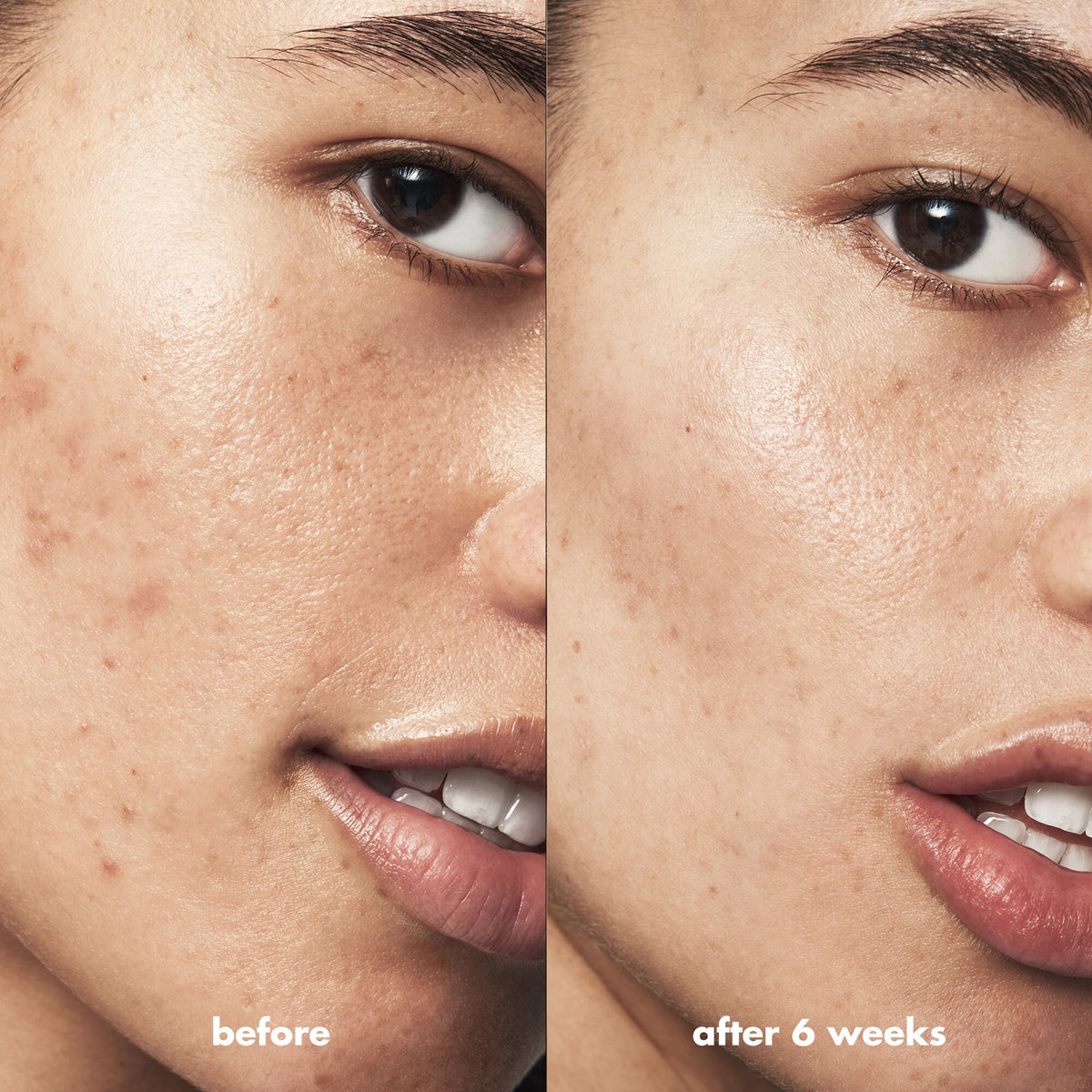 Blemish Breakthrough Triple-acid Resurfacing Serum